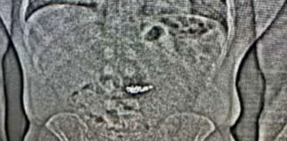 Recuperan unos pendientes de Tiffany & Co. que el ladrón se había tragado